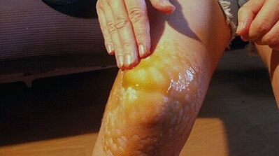 Friction for the treatment of knee joint arthrosis