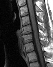 radiograph of the thoracic spine