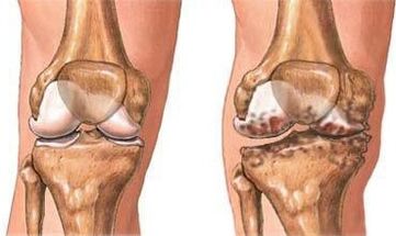Arthritis