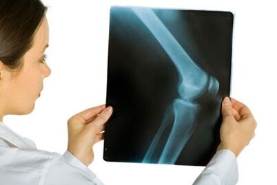 The treatment of arthrosis of the knee joint