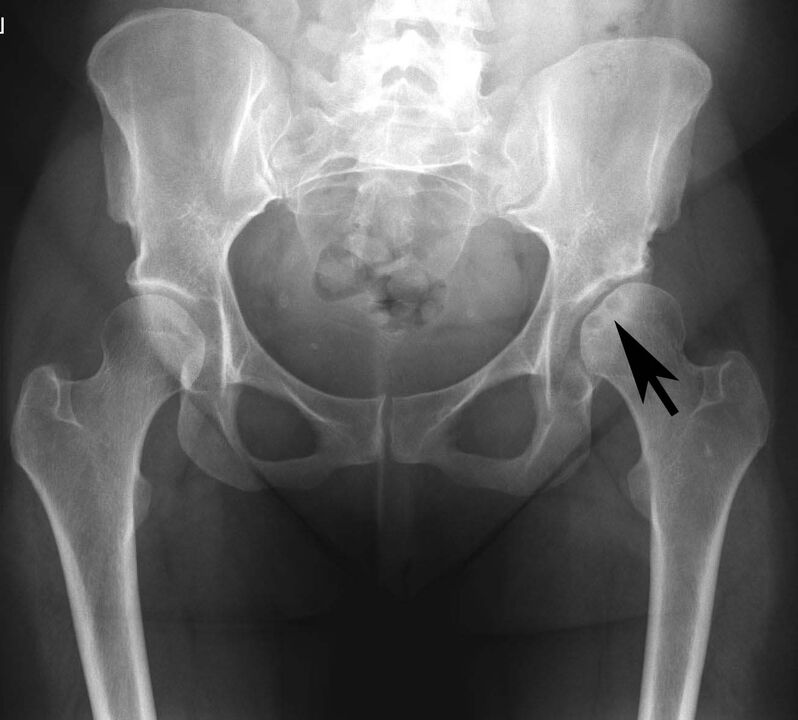 Deposition of calcium salts in the femoral joint with pseudogram on radiography