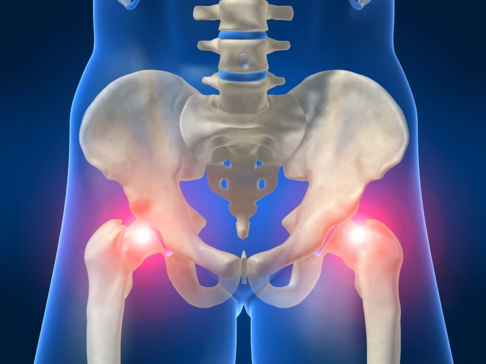 In ankylosing spondylitis, bilateral pain in the hip joint is troubling